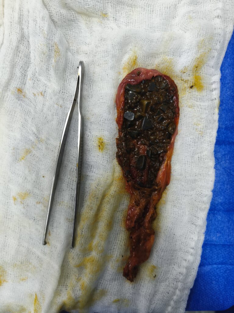 Vesícula con múltiples cálculos en su Interior complicada por cuadro de colecistitis aguda. Operada por el dr José Miguel González cirujano general especialista en laparoscopia avanzada en Valencia y Caracas.