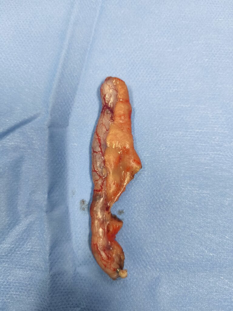 Apendice en fase catarral operada por vía laparoscopica por apendicitis aguda. Operada por el dr José Miguel González cirujano general especialista en laparoscopia avanzada. 